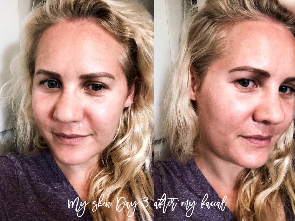LaseMD Laser Facial Treatment, Laser Skincare Treatment, Refined Dermatology, Bay Area Skincare, Have Need Want