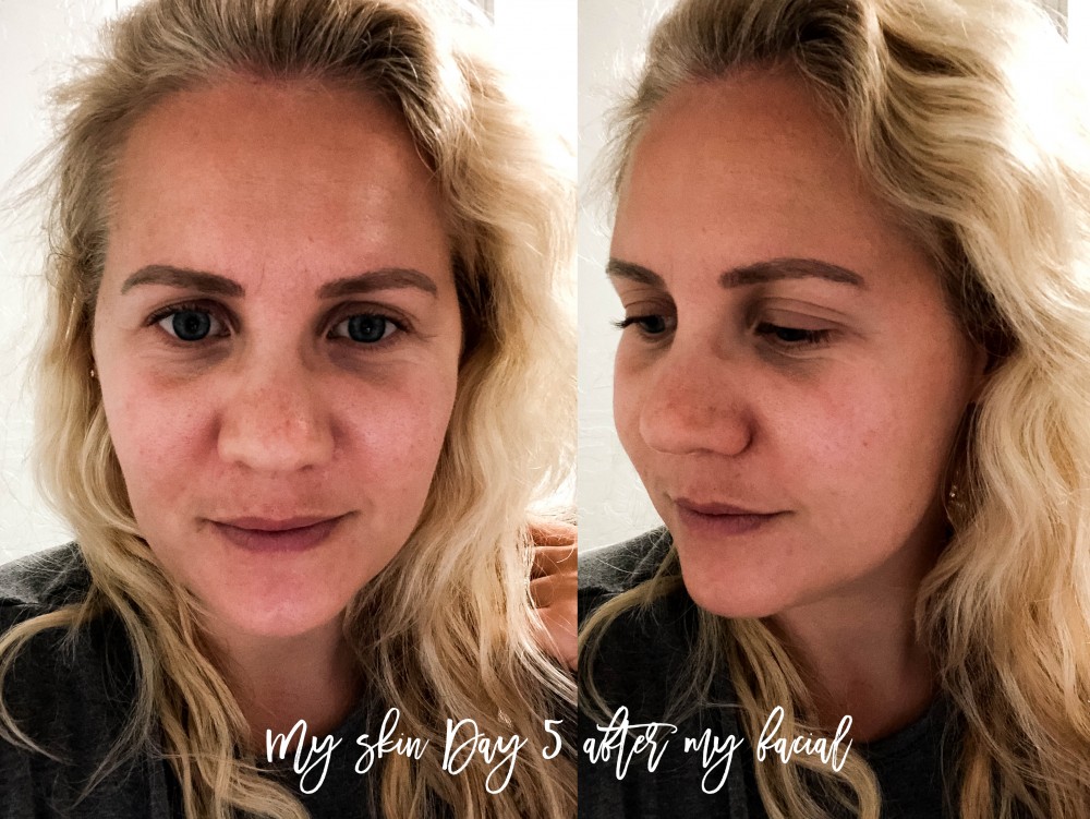 LaseMD Laser Facial Treatment, Laser Skincare Treatment, Refined Dermatology, Bay Area Skincare, Have Need Want