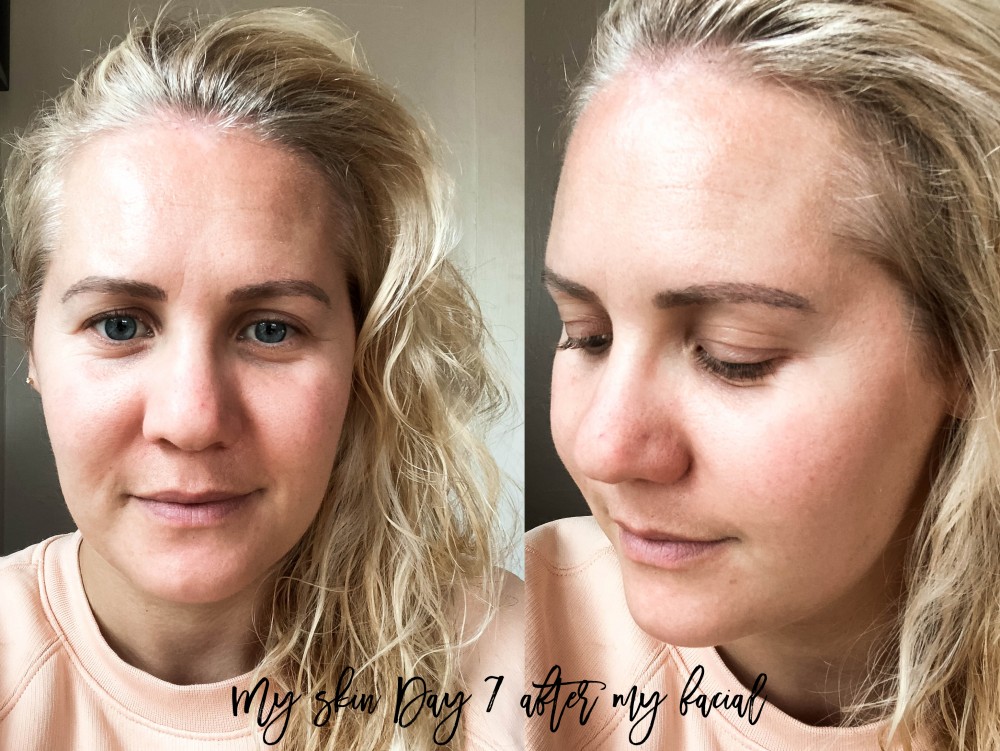 LaseMD Laser Facial Treatment, Laser Skincare Treatment, Refined Dermatology, Bay Area Skincare, Have Need Want