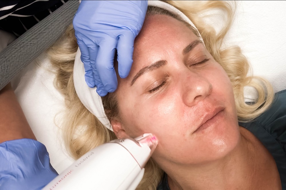 LaseMD Laser Facial Treatment, Laser Skincare Treatment, Refined Dermatology, Bay Area Skincare, Have Need Want